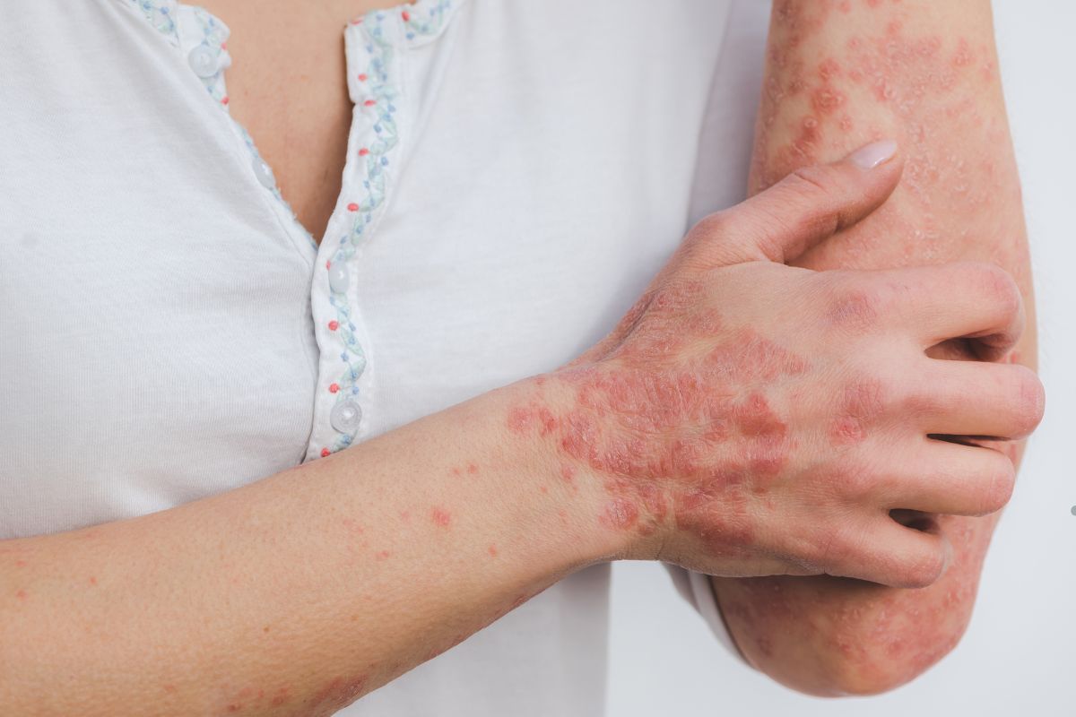 A close-up of a woman's arm showing red skin irritation, likely caused by mold exposure.